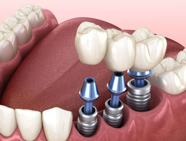 Dental Implant Ann Arbor