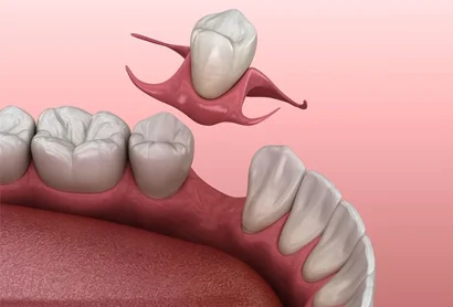 Immediate Dentures- Stadium Family Dentistry
