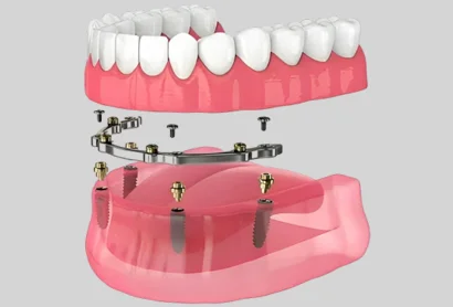 Implant Supported Dentures