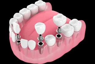 Multiple Tooth Dental Implants