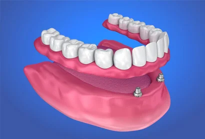 Overdentures - Stadium Family Dentistry