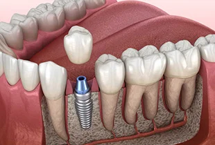 Single Tooth Implants