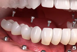 Full Mouth Dental Implants 