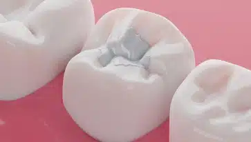 Tooth-Colored Fillings